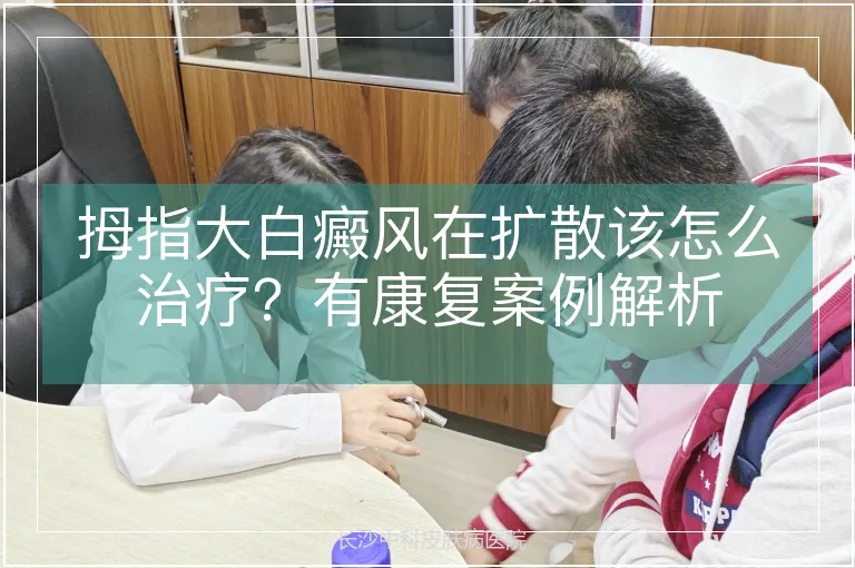 拇指大白癜风在扩散该怎么治疗？有康复案例解析