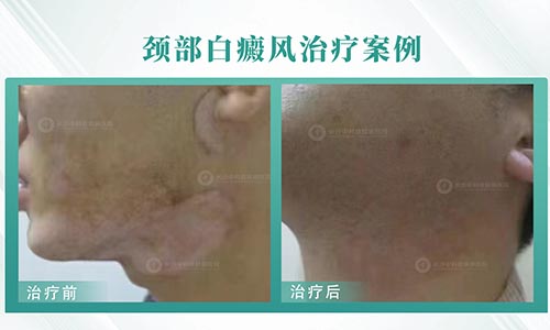 女，6岁 颈部白癜风1年